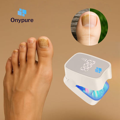 OnyPure™ - Solution Laser LED Avancée contre l’Onychomycose